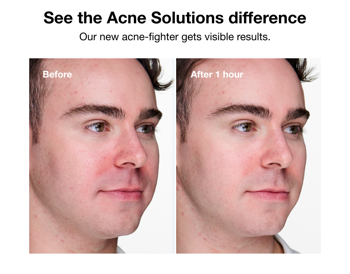 See the Acne Solutions difference | Our new acne-fighter gets visible results. | Before | After 1 hour